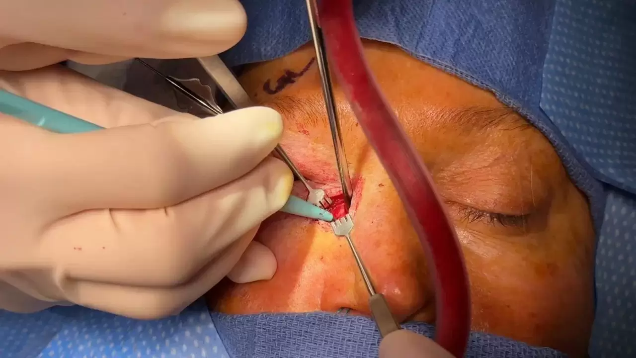 جراحی انسداد مجرای اشک